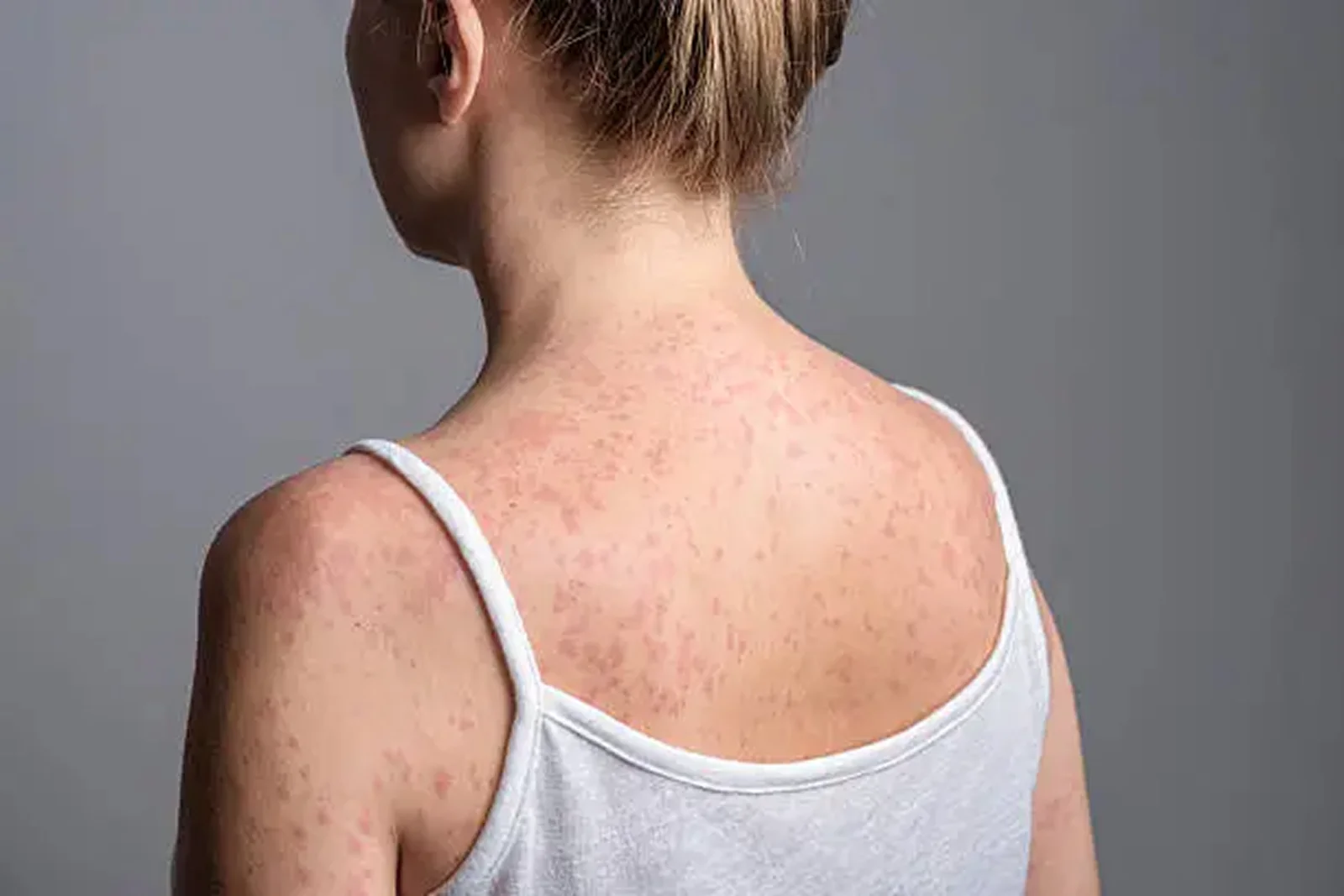 Measles Has Not Disappeared, So Here is How to Recognize It In Your Child